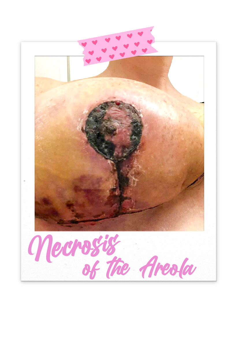 Necrosis of the Areola 