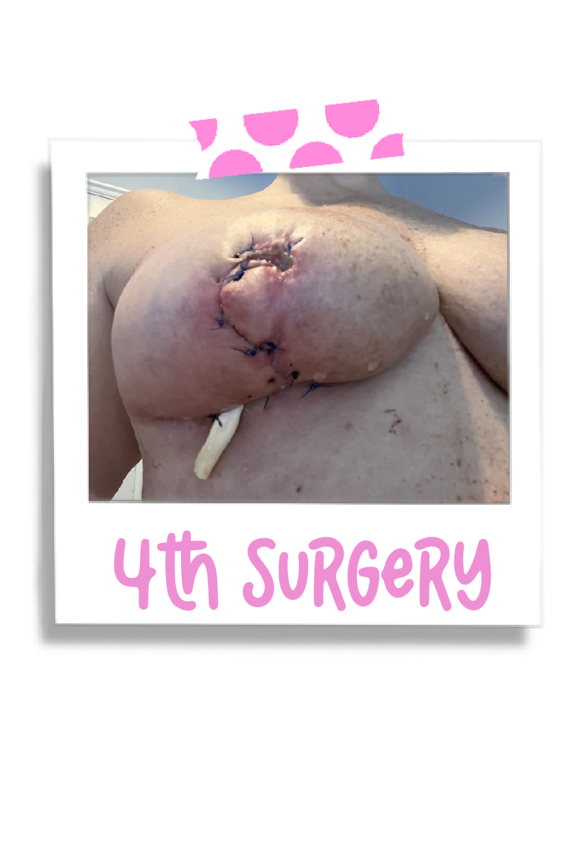 4th breast surgery