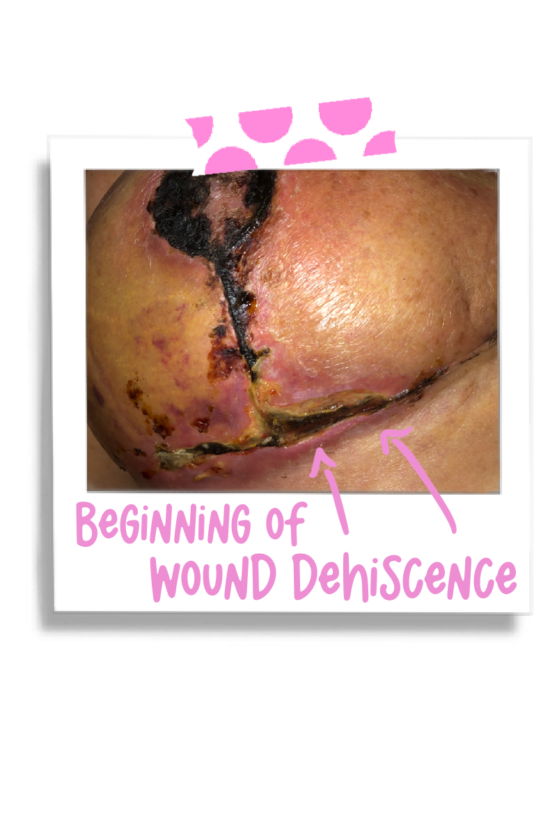 Necrosis and Wound Dehiscence