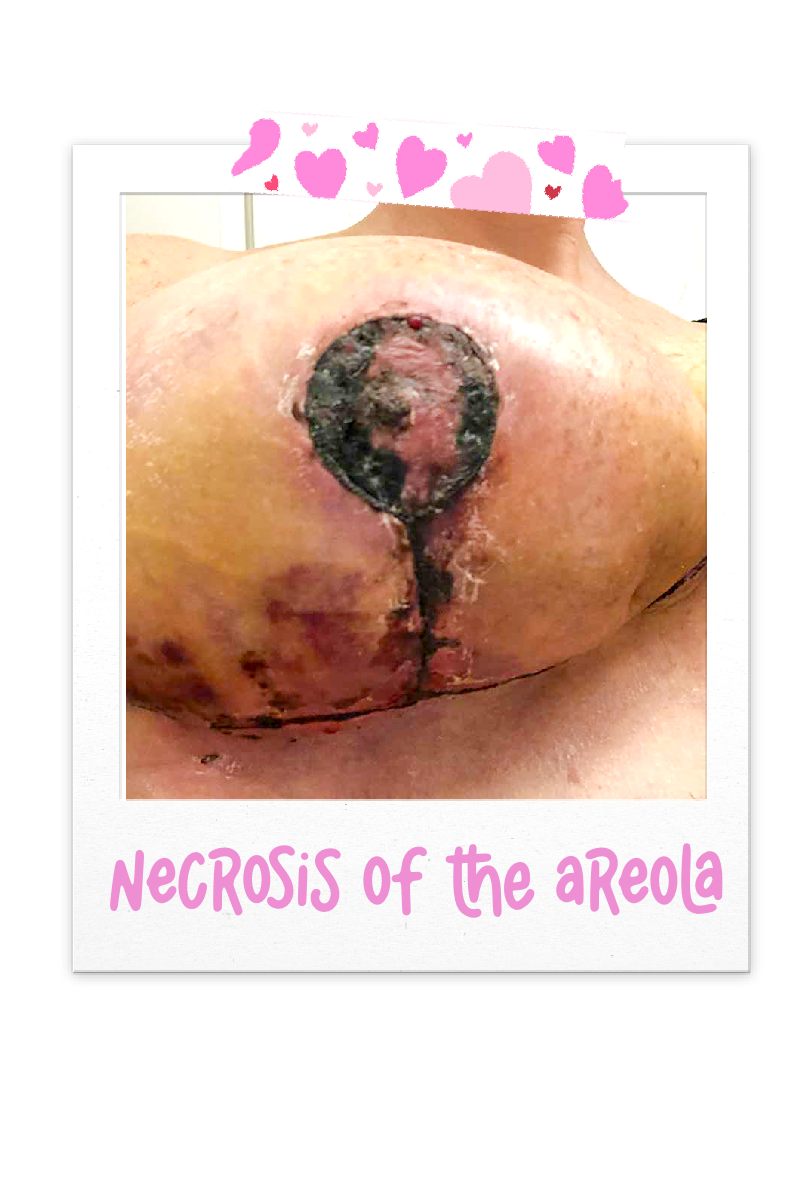Necrosis Of The Areola