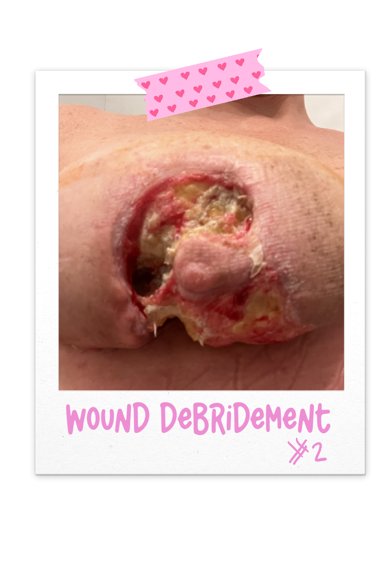 Wound Debridement
