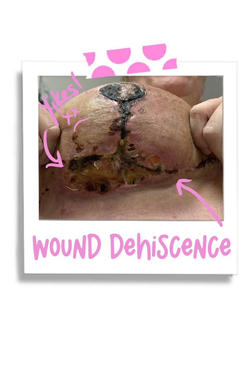 Necrosis and Wound Dehiscence