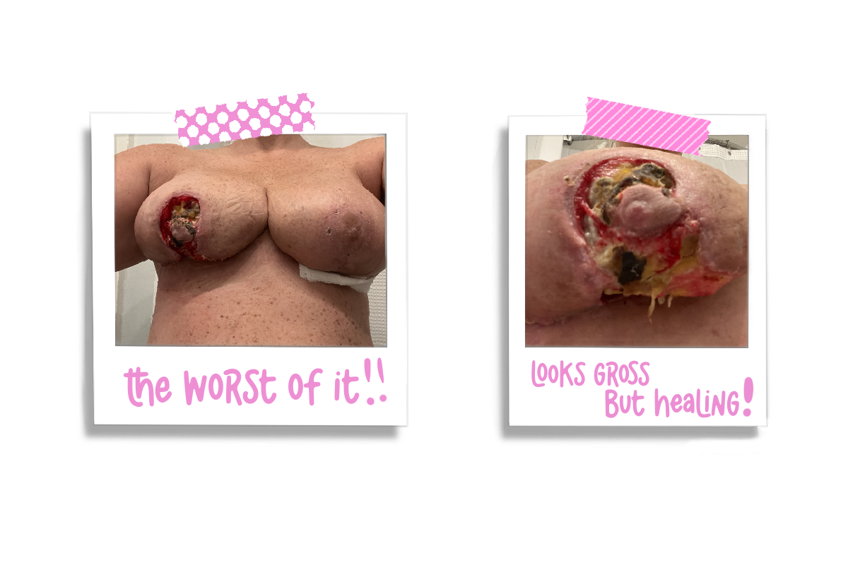 wound care of the right breast