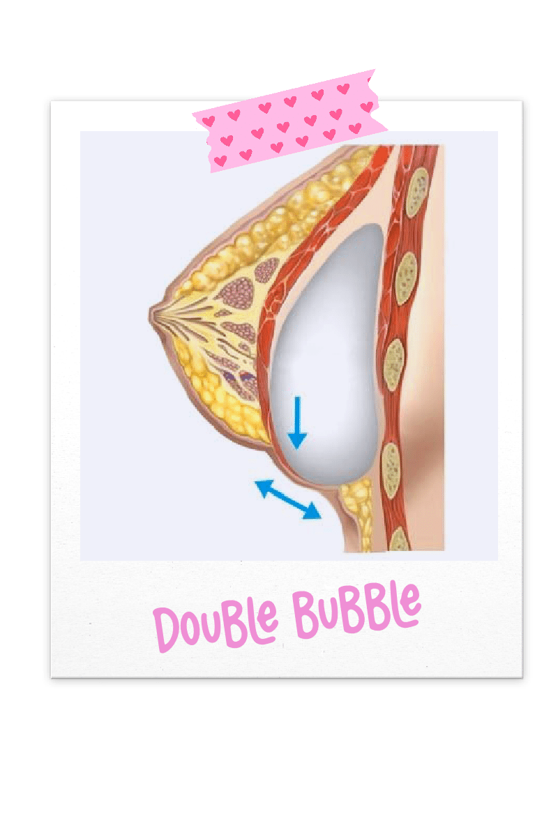 Breast implant double bubble